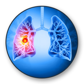 Lung Cancer