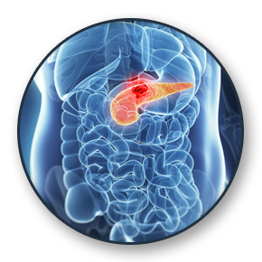 Pancreatic Cancer