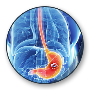 Stomach Cancer