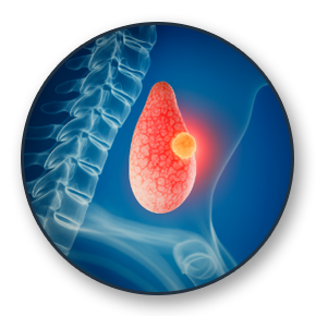 Testicular Cancer