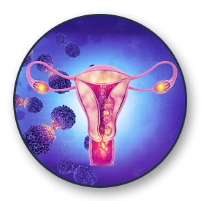 Cervical Cancer